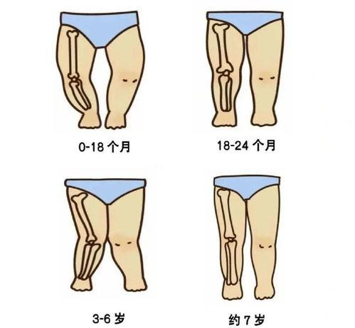 婴儿标准腿型图片,从图片看宝宝健康发育